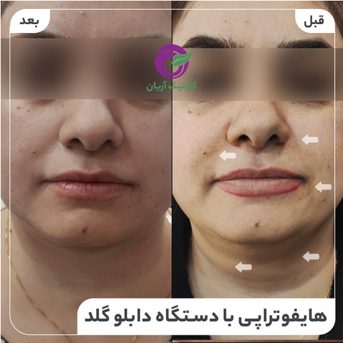 گالری هایفوتراپی